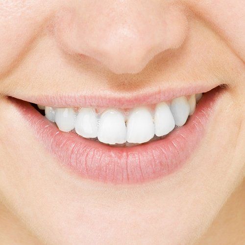 Blanqueamiento dental en Valladolid